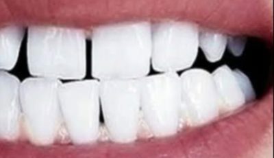 Remove Tartar and Whiten Your Teeth Naturally with Sage Leaves
