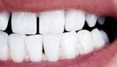 Remove Tartar and Whiten Your Teeth Naturally with Sage Leaves