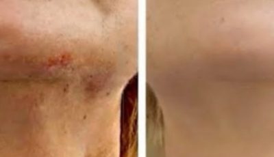 Bay Leaf Is 100,000 Times Stronger Than Botox? | Natural Wrinkle Eraser Even at Age 70!