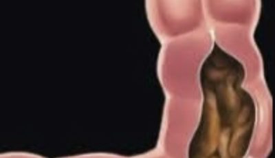 Drink Just 1 Glasses and Cleanse Your Entire Colon in 10 Minutes! Can’t Poop? This Morning Drink Will Clear You Out Fast