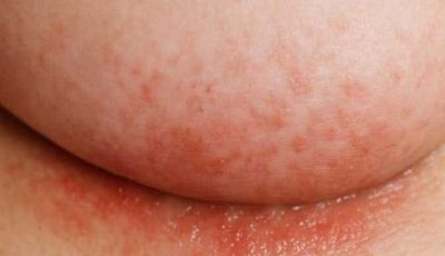 What to Do Today if You Have an Itchy Rash Under Your Breasts in Winter