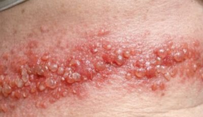 Mom has this blistering rash wrapping around her side. She says the burning pain is unbearable. ER wait is 8 hours! What can we do?