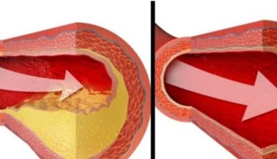 Only One Glass of This Juice… Reverse Clogged Arteries  Lower High Blood Pressure Naturally!
