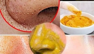 Dites adieu aux points noirs et aux boutons ! Éliminez-les naturellement à la maison… Pour continuer à recevoir mes recettes, il vous suffit de laisser un commentaire… Merci !