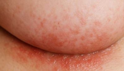 An itchy rash keeps flaring up under my breasts in winter, but my doctor isn’t available right now. What can I do today?