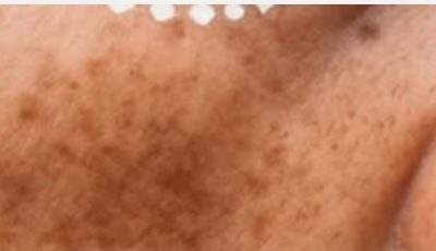 Dark Spots? Pigmentation? Not Anymore! Try This Magic Night Cloves Oil